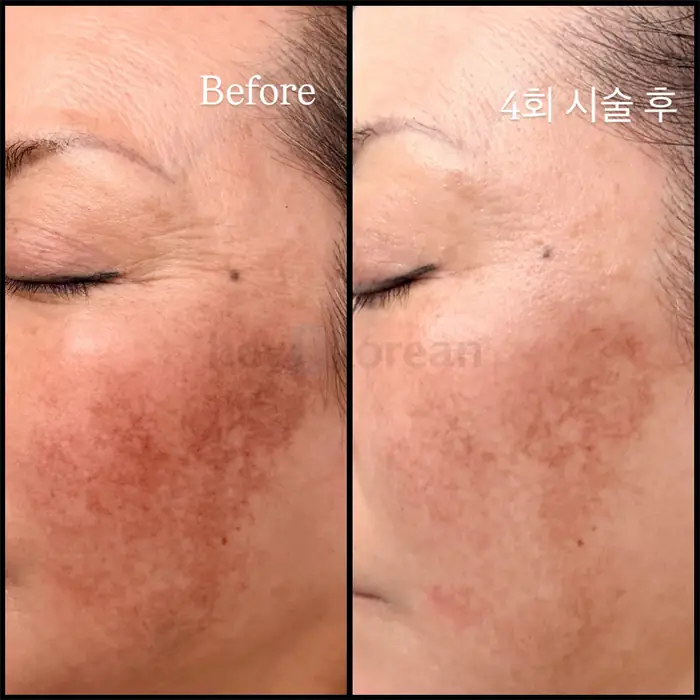 뉴저지 기미 전문 스킨케어 in Bergen County, NJ